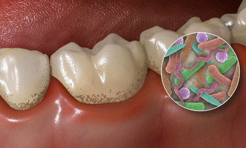 По состоянию микробиома рта можно диагностировать диабет