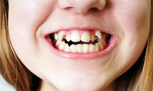 Обнаружен ген, вызывающий появление лишних зубов